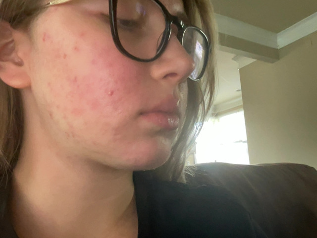 Emma G. after treatment