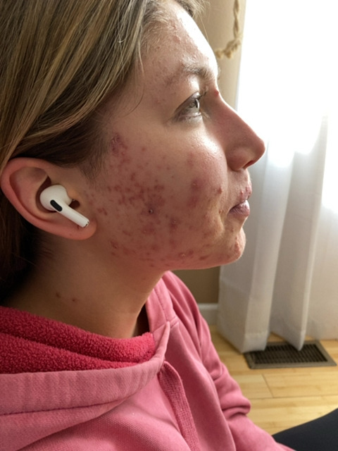 Emma G. before treatment